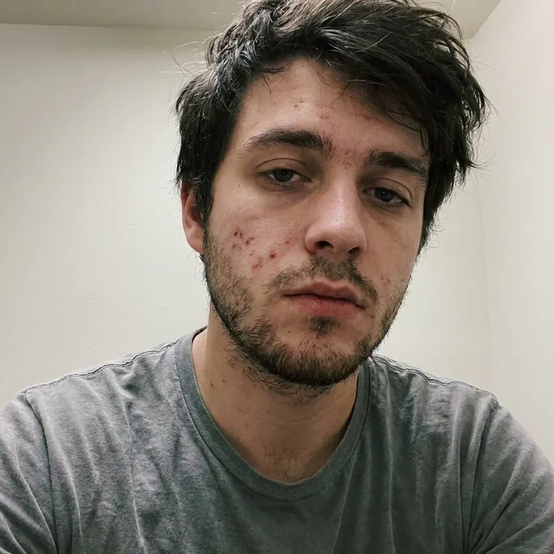 AI demo face before glow-up: a tired man with mild acne, stubble and messy hair in flat light